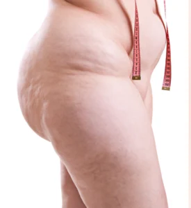 Cellulit potrzebuje zaopiekowania od środka.